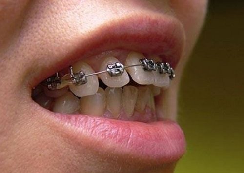 Niềng răng lúc nào đau nhất? Tìm hiểu quy trình 1