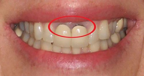 Trồng răng sứ bị đen chân răng nên làm gì? Tìm hiểu về răng sứ 1