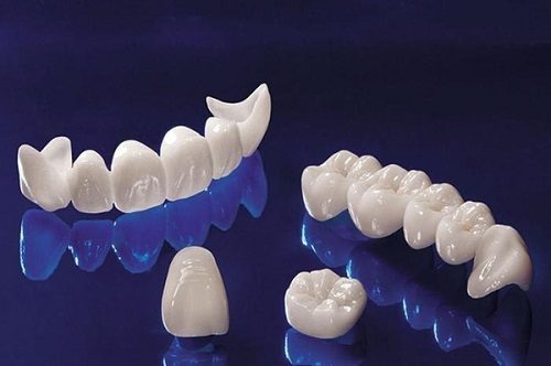 Lựa chọn răng toàn sứ để kéo dài tuổi thọ cho răng*
