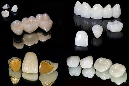 Trồng răng sứ bị đen chân răng nên làm gì? Tìm hiểu về răng sứ 3