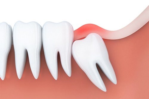 4 răng khôn mọc lệch giải pháp xử lý cho bạn 1