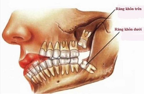 Nhổ 2 răng khôn hàm trên - Thông tin cần biết 1