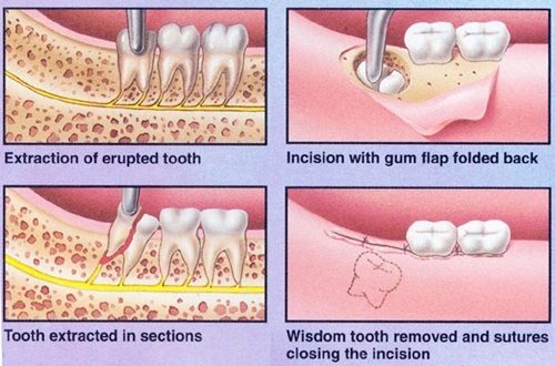Nhổ 2 răng khôn hàm trên - Thông tin cần biết 2