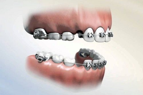 Niềng răng phải nhổ răng nào? Có bắt buộc nhổ răng không? 2