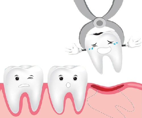 Niềng răng phải nhổ răng nào? Có bắt buộc nhổ răng không? 3