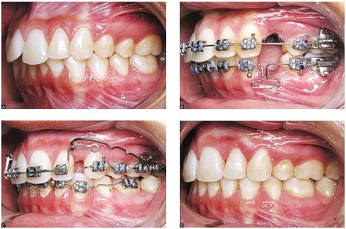 Niềng răng xong bị móm - Cách khắc phục hiệu quả 2