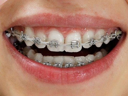 Niềng răng bị viêm lợi - Nguyên nhân và cách khắc phục 1