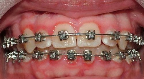 Niềng răng bị viêm lợi - Nguyên nhân và cách khắc phục 2