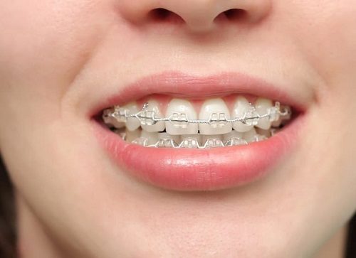 Niềng răng xong có nên tẩy trắng răng không? 1