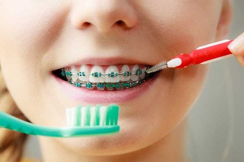 Niềng răng có nên dùng bàn chải điện? Cần lưu ý gì? 2