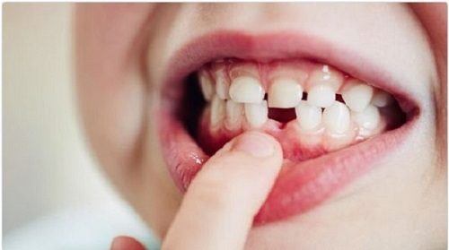 Trẻ em có trồng răng implant được không? 1