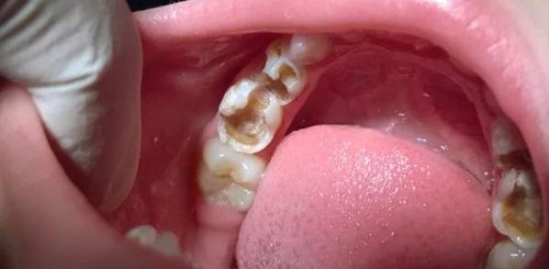 Có nên hàn răng cho bé 3 tuổi không? 1