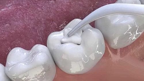 Có nên hàn răng cho bé 3 tuổi không? 2