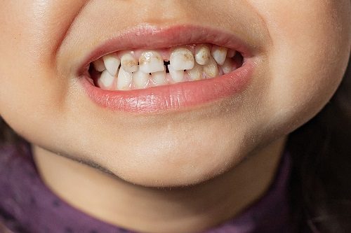 Răng trẻ em bị ố vàng - Biện pháp xử lý hiệu quả 1