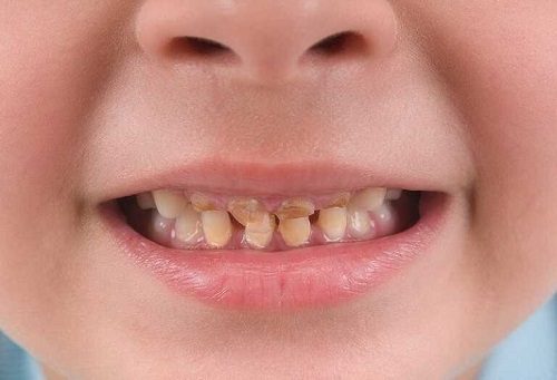 Răng trẻ em bị ố vàng - Biện pháp xử lý hiệu quả 2